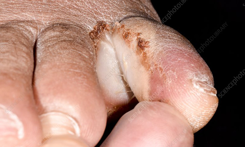 Fungal infection/ interdigital maceration