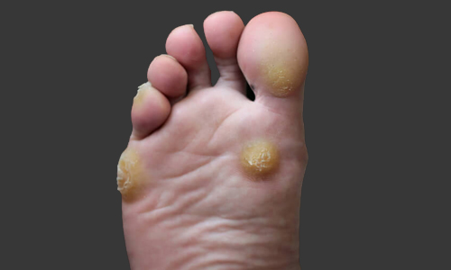 Hypertrophic skin lesions