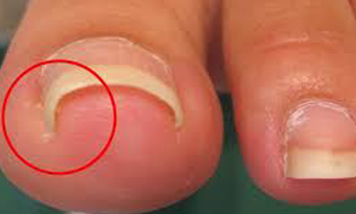 Ingrown or elongated nails